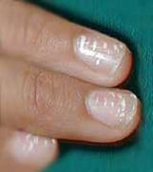 Найдены причины полосок на ногтях